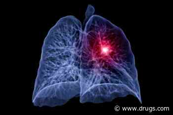 Model Can Accurately Predict Future Lung Cancer Risk From Low-Dose CT