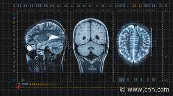 Rest isn't necessarily best for concussion recovery in children, study says