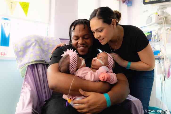 3-month-old conjoined twins separated in historic surgery at Texas hospital