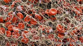 'Microclots' could help solve the long COVID puzzle - National Geographic