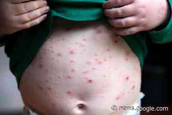 Introducing routine chickenpox jabs for children 'could end risky pox ... - Dudley News