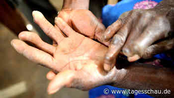 Vergessene Tropenkrankheit: Gelingt es, Lepra auszurotten?