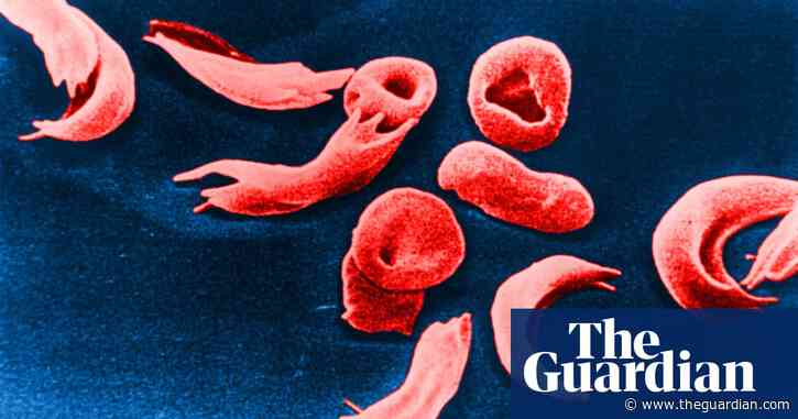 Sickle cell disease patients feel neglected by NHS England, report says