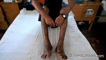 Rivers treats 26 patients, expand healing centres on World Leprosy ... - Guardian Nigeria