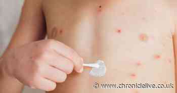 How to treat chickenpox at home and whether you can get a vaccine - dos and don'ts for parents