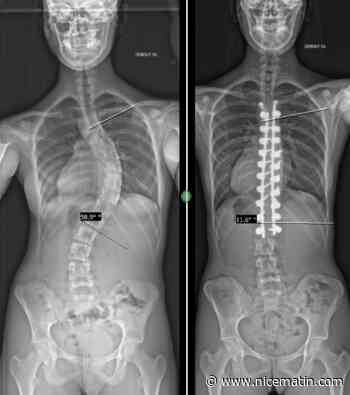Scoliose de l’enfant: les derniers progrès de la chirurgie