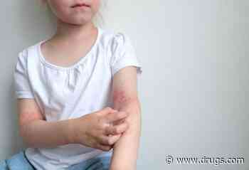 Global Prevalence of Eczema Estimated for Children, Teens