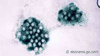 What to know about norovirus as it spreads across the US