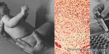 Mississippi hit by 900% increase in newborns treated for syphilis