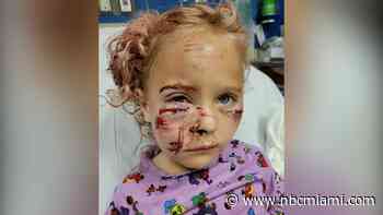 5-Year-Old Recovers From Brutal Dog Attack in Fort Lauderdale, Animal Control Investigates