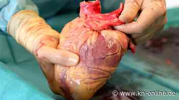 Organspende: Wie machen es eigentlich andere EU-Länder?