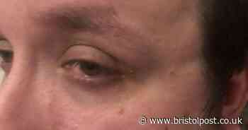 Bristol man speaks out after police pepper-sprayed and restrained him by mistake