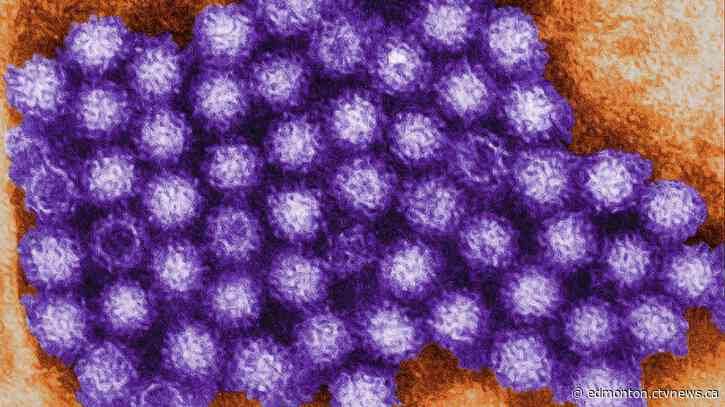 What you need to know about Norovirus as cases see slight rise in Alberta