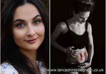 Darwen woman models the painful reality of endometriosis in campaign