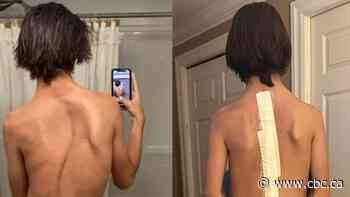 This teen's scoliosis surgery at McMaster Children's Hospital was delayed five times
