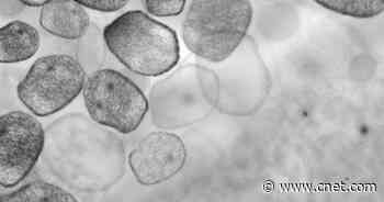 Thousands Possibly Exposed to Measles in Kentucky, CDC Says     - CNET