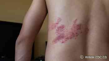 Shingles vaccine should be provided for free to all Albertans 50-plus, doctors say