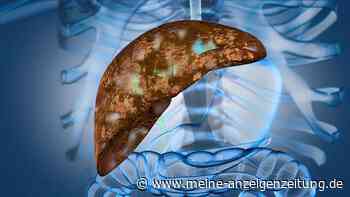 Unentdeckte Fettleber: Leberzirrhose mit vier lebensgefährlichen Komplikationen können die Folge sein