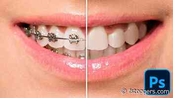 How to Remove Braces Using Photoshop
