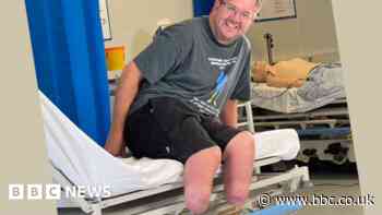 Sepsis: What losing his legs taught surgeon about life