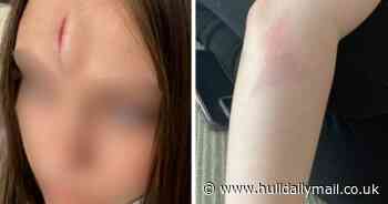 Schoolgirl left with nasty lump on head after boy 'kicked cubicle door in unisex school toilets'