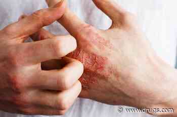 Lebrikizumab Effective for Adults, Teens With Atopic Dermatitis