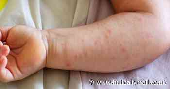 NHS told to stop prescribing one type of eczema treatment