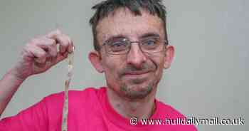 Man who thought he was just 'small for his age' grew 18 inches - after having a brain tumour removed