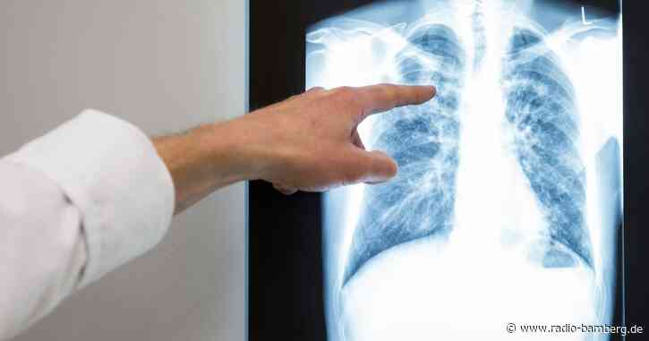 Etwas mehr Tuberkuloseerkrankungen 2022 in Bayern