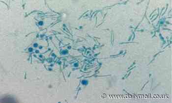 First ever case of human being struck down by killer plant fungus