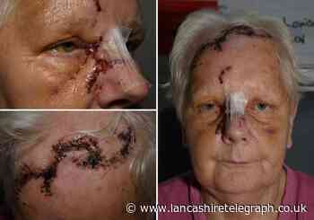 Blackburn pensioner left terrified of dogs following savage attack