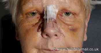 Woman left 'terrified' of dogs after brutal attack by bull terrier