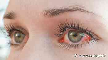 Stop Dry Itchy Eyes With These 7 Home Remedies     - CNET