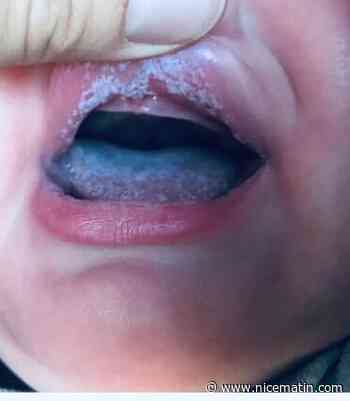 Muguet buccal chez l’enfant: comment le soigner ?
