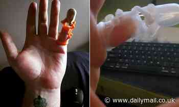 Man who cut off his pinky while drunk 20 years ago FINALLY gets a 3D-printed finger