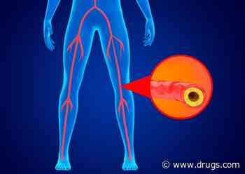 Transcatheter Arterialization Safe for Limb-Threatening Ischemia