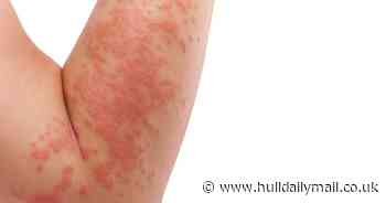 The different types of childhood skin rashes and when to see a doctor