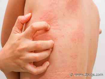 Stress Rash: What Is It and How to Treat It