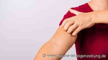 Juckreiz behandeln: Einfaches Hausmittel kann helfen, ihn zu lindern
