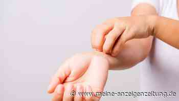 Juckreiz: Neun Dinge, die Betroffene vermeiden sollten