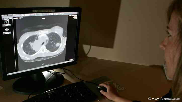 AI model Sybil can predict lung cancer risk in patients, study says