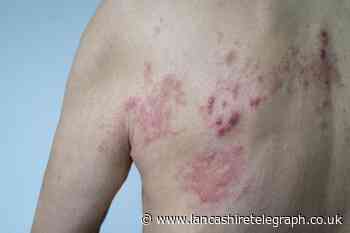 Shingles: What is the cause, can it kill you and more