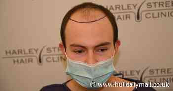 Alex struggled with depression and anxiety after starting to lose his hair at 16