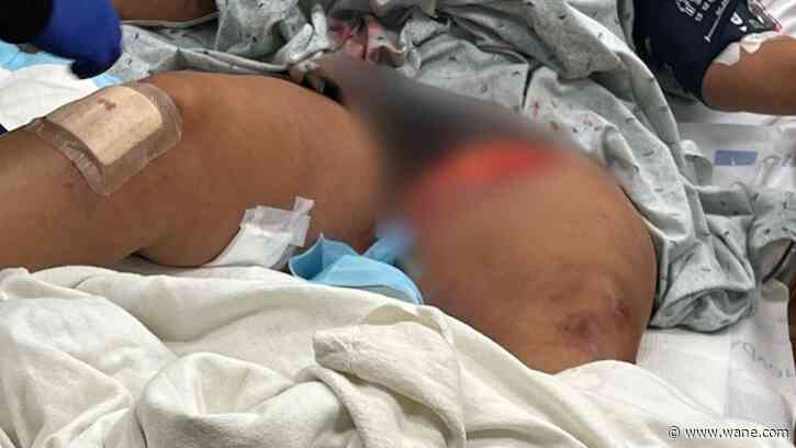 'Superhero' woman left with serious injuries after saving neighbor from pit bull mauling