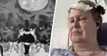 Woman who thought seizures were from pandemic stress had tennis ball-sized brain tumour