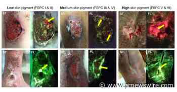 New Publication Reveals MolecuLight Imaging Significantly Improved Detection of Bacterial Burden Across Patients of All Skin Tones