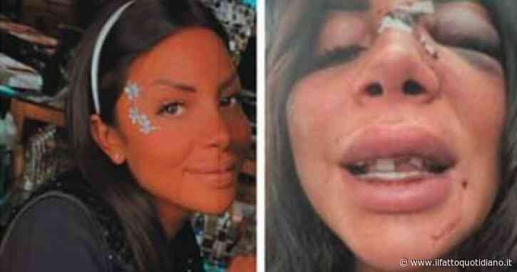 Prato, aggredita e sfregiata mentre rientrava a casa da lavoro: i picchiatori ingaggiati dall’ex. Tre arresti