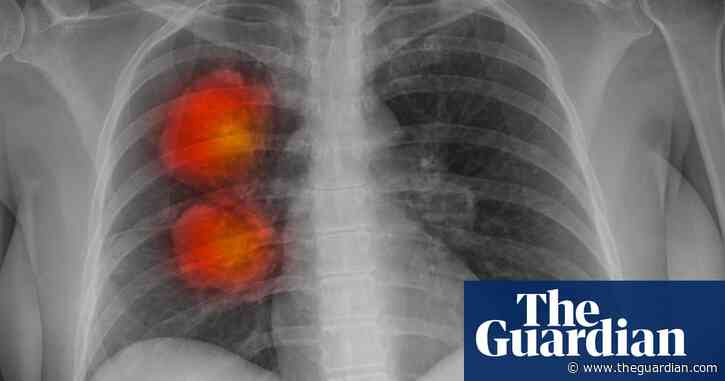 New artificial intelligence tool can accurately identify cancer