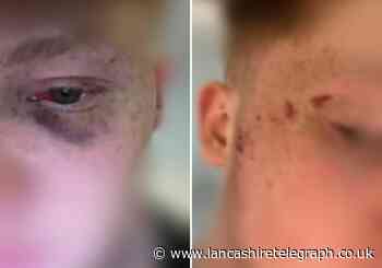 A teen was 'punched' by police following the Rovers v Burnley game