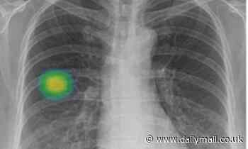 AI 'can accurately spot cancer': Algorithm better at spotting cancerous nodules than other methods